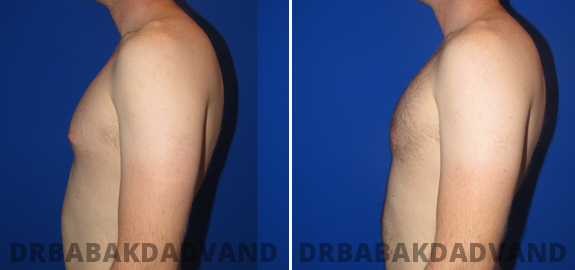 Before and After Photos. Gynecomastia. 2